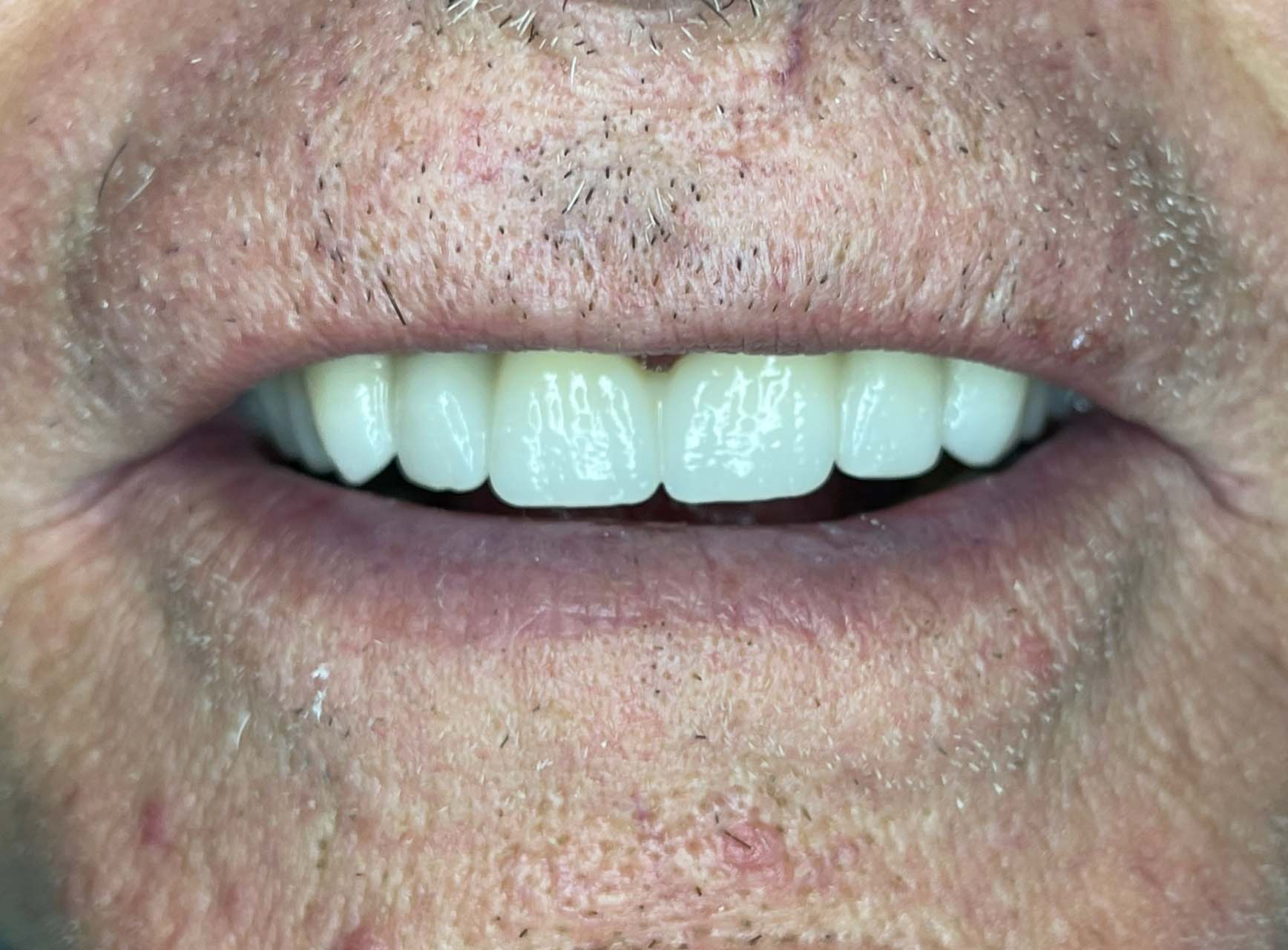 Rehabilitación oral almeria estetica dental