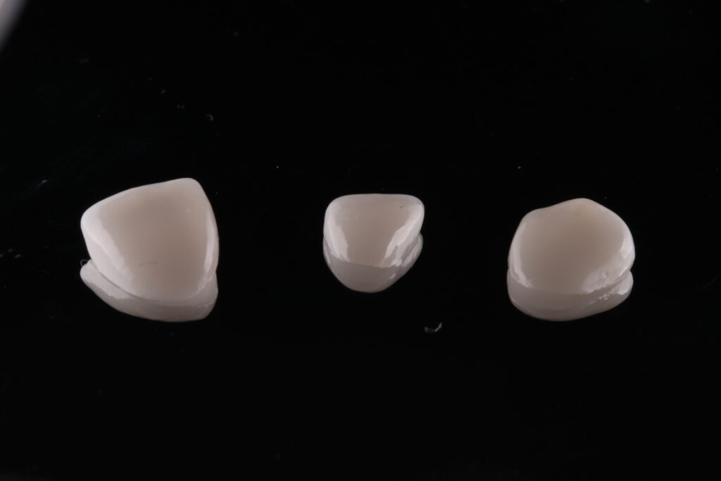 Carillas dentales sin tallado